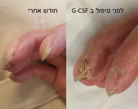 before and after GCSF2