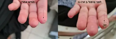 before and after GCSF3